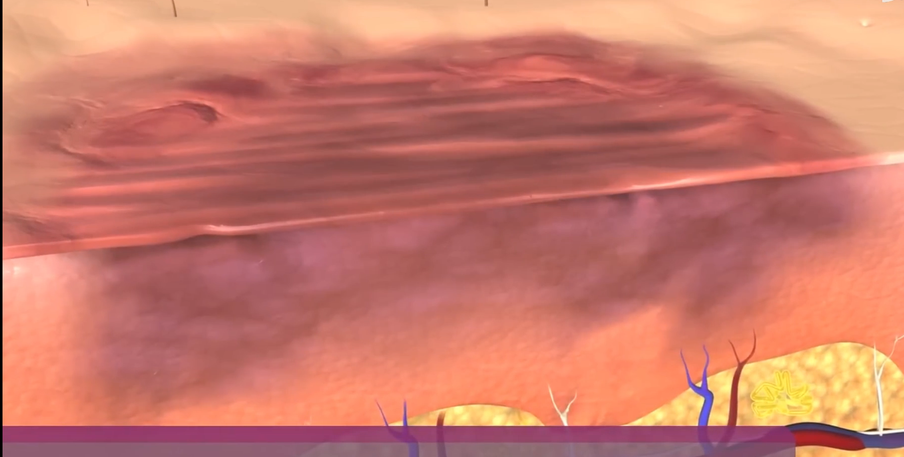 烧伤皮肤受损示意图