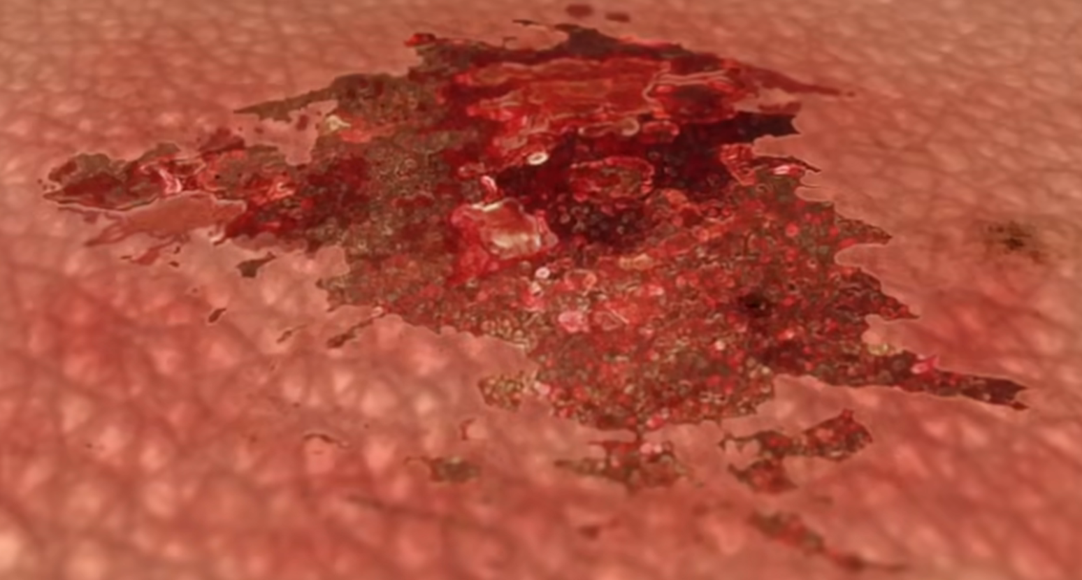 创面暴露示意图