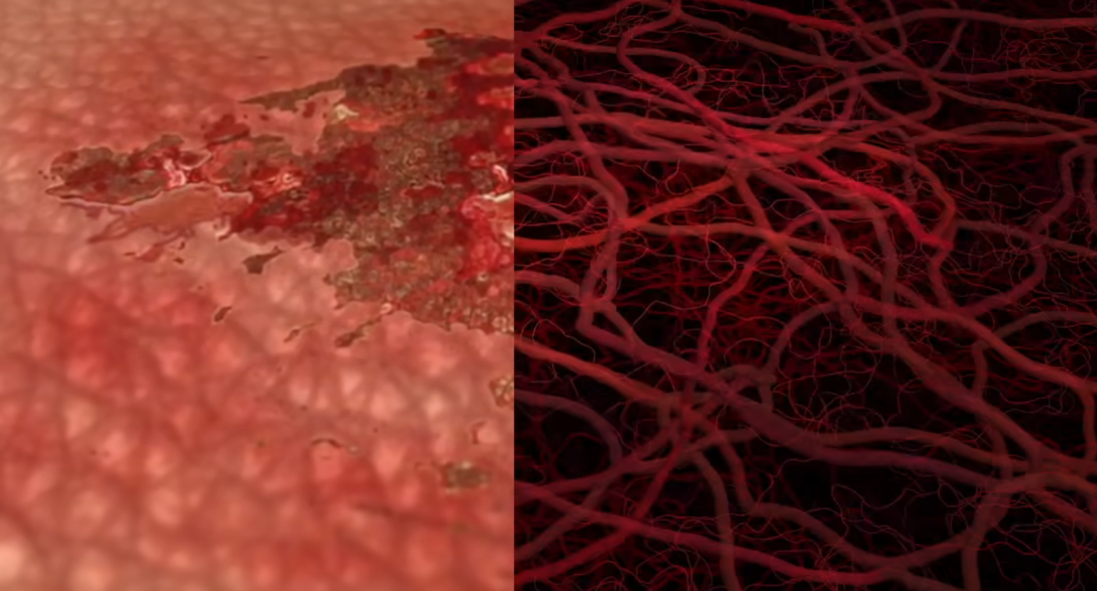 细菌感染扩增示意图